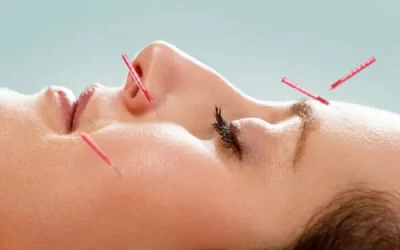 Acupuntura para tratamento de insônia